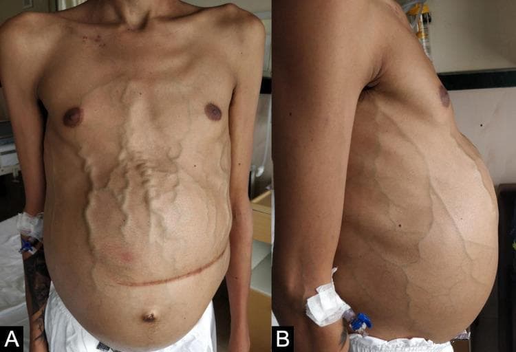 Clinical photograph of a male patient's torso in anterior (A) and lateral (B) views, demonstrating advanced clinical signs of portal hypertension and chronic liver disease. The abdomen is severely distended, consistent with tense ascites. Prominent, tortuous, and dilated superficial veins (caput medusae) are visible across the entire abdominal wall and flanks, radiating from the peri-umbilical region. A well-healed, horizontal surgical scar from a previous splenectomy is present in the mid-abdomen. Additional findings include a small umbilical hernia, bilateral gynecomastia, and significant sarcopenia characterized by muscle wasting in the pectoral region and visible bony landmarks of the clavicles and shoulders. An intravenous cannula is present in the left arm. These visual markers collectively illustrate the systemic manifestations of severe portal venous congestion, commonly associated with conditions such as Gaucher disease or advanced cirrhosis.