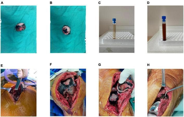 A multi-panel clinical photograph series documenting macroscopic findings of alkaptonuria (ochronosis). Panels A and B show a resected femoral head with severe cartilage destruction and characteristic black/dark brown pigmentation of the articular surface and subchondral bone. Panels C and D illustrate a diagnostic urine test: initial urine (C) appears normal light yellow, while the sample exposed to air for 24 hours (D) shows significant darkening to a chocolate-brown color due to homogentisic acid oxidation. Panels E, F, and G provide intraoperative views of the hip and knee joints, revealing extensive ochronotic pigmentation of the synovial tissues, tendons, and joint capsules, as well as the articular surfaces of the distal femur and patella. Panel H displays the joint following total knee arthroplasty (TKA) prosthesis placement. This collection demonstrates the classic multisystem pigmentary manifestations of ochronosis in orthopedic surgery and clinical biochemistry.