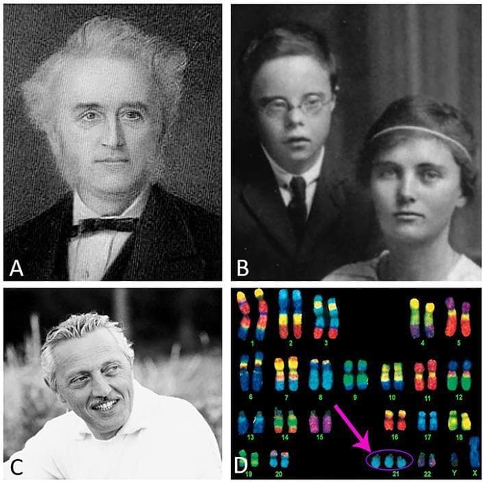 A composite figure illustrating the historical and genetic context of Down syndrome (Trisomy 21). Panel A shows a portrait of John Langdon Down, who first described the clinical features. Panel B is a black-and-white clinical photograph of two individuals; the male exhibits characteristic dysmorphic facial features of Down syndrome, including upslanting palpebral fissures, epicanthic folds, and a flattened nasal bridge. Panel C depicts Dr. Jérôme Lejeune, the geneticist who identified the chromosomal basis of the condition. Panel D shows a spectral karyotype (SKY) or multicolor fluorescence in situ hybridization (m-FISH) arrangement. All autosomal pairs are numbered 1 through 22, along with X and Y sex chromosomes. A pink arrow highlights the genetic hallmark of the disorder: three copies of chromosome 21 (Trisomy 21) instead of the typical homologous pair. This educational graphic links clinical phenotype with its underlying cytogenetic pathology, suitable for medical genetics and pediatrics curricula.