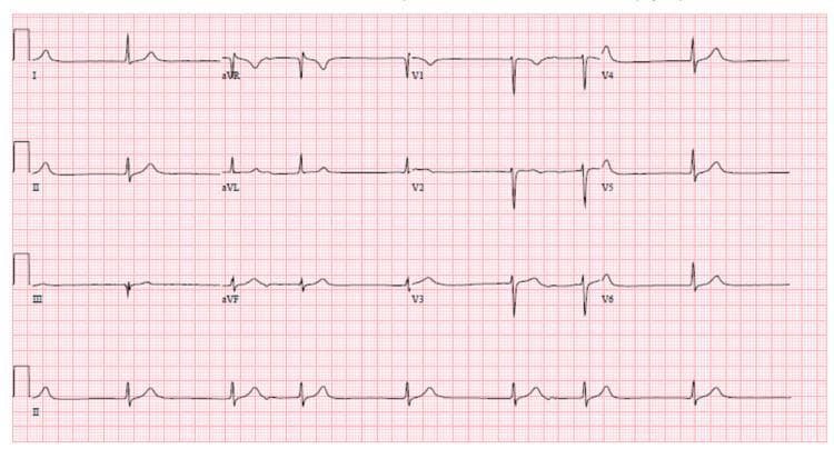 A 12-lead electrocardiogram (ECG) with a rhythm strip (Lead II) at the bottom, demonstrating a complex arrhythmia characterized by 'escape-capture bigeminy'. The tracing shows a slow junctional rhythm competing with sinus activity. Key features include an irregular rhythm with alternating morphology: narrow QRS complexes (captured beats) follow P-waves with a prolonged PR interval, while wider or differently contoured complexes represent junctional escape beats. This pattern results in a repetitive bigeminal sequence. The baseline rate is bradycardic with evidence of a slow ventricular response. Distinct P-waves are visible in several leads but show variable relationship to the QRS complexes, indicating a degree of AV dyssynchrony. T-waves are generally upright and morphology is otherwise stable with a QTc interval of approximately 410 msec. This ECG illustrates electrophysiological changes often associated with metabolic derangements or drug toxicities, such as lithium toxicity, affecting the cardiac conduction system.