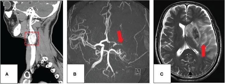Multi-modal diagnostic imaging of a 60-year-old patient illustrating a carotid body tumor (CBT) and a subsequent cerebrovascular complication. Panel A shows a coronal CT angiography (CTA) scan highlighting a well-defined, hypervascular mass in the left carotid space (red box), characteristic of a carotid body tumor splaying the carotid bifurcation. Panel B displays an axial maximum-intensity-projection (MIP) from a Magnetic Resonance Angiogram (MRA) taken post-surgery, revealing a complete occlusion of the left middle cerebral artery (MCA), indicated by a red arrow. Panel C is an axial T2-weighted MRI (T2WI) of the brain demonstrating a large, acute ischemic infarction throughout the left MCA territory (red arrow). The infarction is identified by significant hyperintense signal and associated vasogenic edema, causing a midline shift and compression of the left lateral ventricle. This series illustrates the diagnostic appearance of CBT and the risk of major ischemic stroke following surgical intervention or internal carotid artery occlusion.