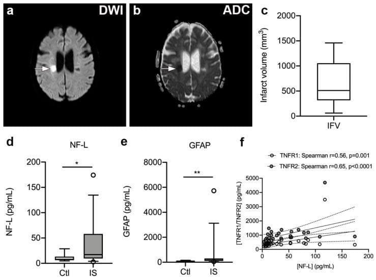 This composite image illustrates diagnostic findings and biomarker data from ischemic stroke (IS) patients. (a, b) Axial brain MRI scans showing a subcortical lacunar infarct in the right hemisphere. Panel (a) is a Diffusion-Weighted Imaging (DWI) sequence where the acute infarct appears as a bright hyperintense lesion (white arrow). Panel (b) is the corresponding Apparent Diffusion Coefficient (ADC) map, showing the same lesion as a dark hypointense area (white arrow), confirming restricted diffusion. (c) A box plot representing the infarct volume distribution (mm³) among IS patients. (d, e) Comparative box plots showing significantly elevated serum levels of Neurofilament light chain (NF-L) and Glial Fibrillary Acidic Protein (GFAP) in IS patients versus healthy controls (Ctl), indicating neuro-axonal and glial damage. (f) A correlation plot with linear regression and 95% confidence intervals demonstrating positive associations between serum NF-L and plasma TNFR1 and TNFR2 levels. These data illustrate the relationship between structural brain injury, inflammatory signaling, and biomarker release post-ischemic stroke.