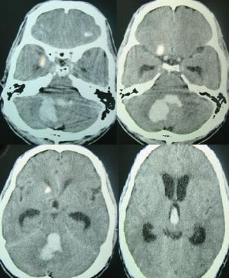 This diagnostic image consists of four axial non-contrast CT scan slices of the brain, demonstrating acute intracranial pathology. The primary finding is a large, irregularly shaped hyperdense area in the posterior fossa, consistent with an acute cerebellar hemorrhage. This hematoma exerts significant mass effect on the fourth ventricle and brainstem. Secondary findings include intraventricular hemorrhage (IVH), visible as hyperdense material settled within the lateral and third ventricles. There is evidence of obstructive hydrocephalus, characterized by the enlargement of the frontal horns of the lateral ventricles and the temporal horns. Smaller hyperdense foci are also noted in the supratentorial region, which may represent secondary parenchymal extension or hypertensive bleeds. This clinical case illustrates the radiographic presentation of a hypertensive posterior fossa bleed leading to secondary ventricular obstruction and acute hydrocephalus, a critical neurosurgical emergency.