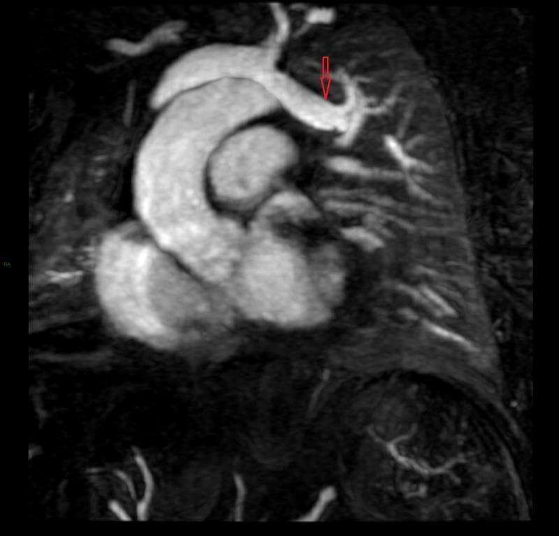 Diagnostic cardiac MRI (magnetic resonance imaging) scan in a coronal reconstruction illustrating a case of Partial Anomalous Pulmonary Venous Return (PAPVR). The image displays the heart, aortic arch, and superior vena cava within the thoracic cavity. A red arrow highlights a specific anomalous pulmonary vein that originates from the left upper lobe of the lung. Instead of its normal physiological drainage into the left atrium, the vessel is clearly visualized coursing superiorly and medially to connect directly to the left brachiocephalic (innominate) vein. This anatomical variation represents a left-to-right cardiovascular shunt. The image serves as a clinical example of congenital pulmonary venous anomalies that can lead to right ventricular volume overload and pulmonary hypertension. Key landmarks such as the ascending aorta and the bifurcation of the pulmonary vasculature are also visible, providing spatial context for the anomalous vessel's path above the heart.