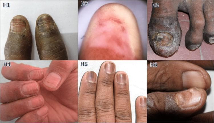 A clinical compilation of six photographs (H1-H6) demonstrating various drug-induced nail pathologies. H1 shows doxorubicin-induced chromonychia with longitudinal pigmented bands and nail plate discoloration. H2 illustrates drug-induced anonychia, showing complete absence of the nail plate with residual erythematous nail bed. H3 displays severe carboplatin-induced onychodystrophy of the great toenail, characterized by marked thickening (pachyonychia), brownish-gray discoloration, and surface irregularity. H4 depicts cisplatin-induced Beau's lines, visible as horizontal grooves or transverse depressions across multiple fingernails. H5 shows zidovudine-induced longitudinal melanonychia, presenting as dark vertical bands extending from the proximal nail fold. H6 demonstrates gemcitabine-induced onychomadesis, showing proximal separation of the nail plate from the nail bed. These images serve as educational examples of chemotherapy and anticonvulsant-associated dermatological side effects, illustrating diverse morphological changes in the nail unit including alterations in color (chromonychia), structure (dystrophy), and attachment (onychomadesis).