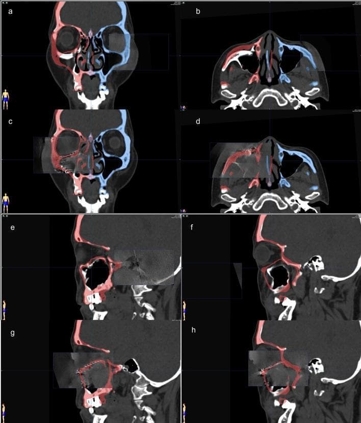 This composite diagnostic image demonstrates the use of surgical navigation and 3D C-arm computed tomography (CT) in the management of complex maxillofacial trauma. Panels a-d show coronal and axial CT views with color-coded overlays from presurgical planning. The blue overlay on the patient's left side represents the unaffected anatomical template, which is mirrored to the right side (red overlay) to guide the reduction of a comminuted zygomatic fracture and reconstruction of a blowout orbital floor fracture. Panels c and d specifically show the intraoperative fusion of 3D C-arm data with the virtual plan, verifying the alignment of bone fragments and the positioning of titanium implants. Panels e-h provide sagittal views comparing the preoperative state (e, f), characterized by orbital floor discontinuity and herniation of contents, with the intraoperative state (g, h). The post-reconstruction images (g, h) visualize a titanium mesh implant restoring the orbital floor contour, achieving high conformity with the mirrored surgical plan. This clinical toolset is essential for ensuring facial symmetry and preventing postoperative complications like enophthalmos in craniomaxillofacial surgery.