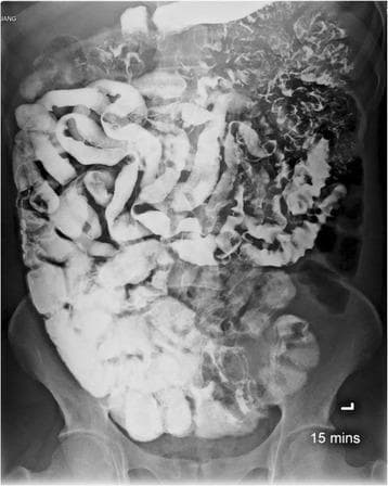 This abdominal X-ray demonstrates a small bowel follow-through (SBFT) study using oral barium contrast. The image reveals significant radiological abnormalities throughout the small intestine, specifically involving the jejunum and ileum. Key findings include a continuous long segment of diffuse mucosal fold thickening and areas of fold effacement, where the normal valvulae conniventes appear flattened or absent. There is evidence of increased luminal fluid, which contributes to the dilution and flocculation of the barium contrast, creating a characteristic 'clumping' or irregular distribution. Morphologically, the bowel loops show varying degrees of luminal narrowing and focal dilatation. These radiographic features are characteristic of malabsorption syndromes and inflammatory processes, specifically associated here with intestinal capillariasis. The 15-minute time marker suggests rapid transit of the contrast through the small bowel, a common feature in protein-losing enteropathies and chronic parasitic infections.