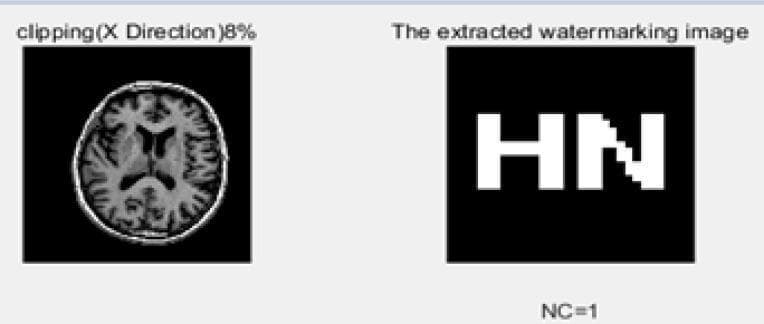 This figure presents a comparative study of digital watermarking robustness in clinical imaging. On the left is a diagnostic image showing a transverse (axial) cross-section of a human brain, likely from a computerized tomography (CT) or MRI scan. The image displays cerebral anatomy, including the ventricular system and cortical folds. Text above this image indicates a 'clipping(X Direction) 8%' attack, a digital manipulation technique used to test the security of embedded data. On the right, the 'extracted watermarking image' is displayed as a pixelated binary image containing the characters 'HN'. Below this, the value 'NC=1' is shown, representing a Normalized Correlation of 1.0. This indicates a perfect match between the original and extracted watermark despite the 8% horizontal clipping attack. This visual illustrates concepts in medical informatics and multimedia security, specifically demonstrating the resilience of watermarking algorithms in protecting the copyright and integrity of medical diagnostic data against geometric distortions.