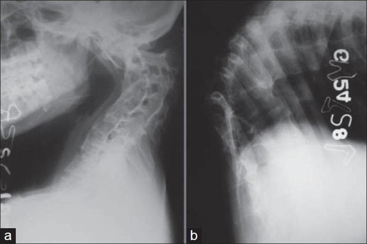 This composite diagnostic image features two lateral plain X-ray radiographs (a and b) illustrating severe spinal deformities resulting from healed spinal tuberculosis (Pott's disease). Image (a) depicts a lateral view of the cervical spine, showing significant anterior wedging and collapse of multiple mid-cervical vertebral bodies. This structural loss has resulted in a marked cervical kyphosis, reversing the normal lordotic curvature. There is visible irregularity of the vertebral endplates and narrowing of the intervertebral disc spaces, suggesting chronic degeneration and secondary fusion. Image (b) shows the thoracic (dorsal) spine, demonstrating an acute, angular kyphotic deformity (gibbus deformity). The X-ray reveals severe anterior collapse of multiple thoracic vertebrae, with the apex of the curve showing significant structural distortion and narrowing of disc spaces. Crowding of the posterior elements and ribs is evident at the apex. Together, these images illustrate the long-term musculoskeletal sequelae of spinal tuberculosis, focusing on severe sagittal plane malalignment and vertebral destruction.