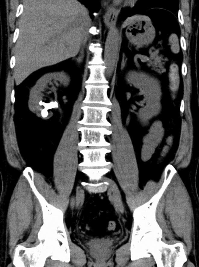 This coronal CT scan of the abdomen and pelvis demonstrates nephrolithiasis within the right kidney. The imaging modality clearly highlights high-density, radio-opaque calcifications located primarily within the right middle and lower renal calyces. The largest stone measures approximately 36 mm in its longest diameter, with a mean attenuation value of 798 Hounsfield Units, indicating high mineral density. Key anatomical landmarks visible include the vertebral column, psoas muscles, and pelvic bones. Both kidneys are identified bilaterally, with the right kidney positioned slightly more inferiorly than the left. There is no evidence of significant hydronephrosis in this view. The image serves as a clinical diagnostic example of symptomatic or asymptomatic renal calculi and is suitable for teaching the radiological identification of stone burden and density calculation using CT imaging in urology.