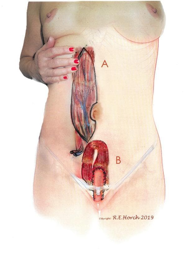 This medical illustration demonstrates the surgical planning for a vertical rectus abdominis myocutaneous (VRAM) flap. Image A shows a preoperative anatomical diagram of the flap donor site on a standing female torso. An elongated, vertical skin island is outlined on the right abdomen, revealing the underlying muscular anatomy, rectus abdominis fibers, and vascular supply, specifically the deep inferior epigastric vessels. The umbilical notch is clearly marked medially. Image B depicts the transposition of this VRAM flap into the pelvic region for reconstruction. The illustration shows the flap being tunneled into the pelvis to serve as a neovagina or to reconstruct the posterior vaginal wall. Surgical sutures and the tubular configuration of the flap are visible in the perineal region, highlighting the clinical application of pedicled muscle flaps in complex oncological or reconstructive pelvic surgery. This visual serves as an educational guide for understanding flap design, vascular pedicles, and reconstructive pathways in gynecological or plastic surgery.
