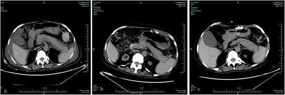 This clinical imaging series comprises three non-contrast axial CT scans (a, b, and c) of the upper abdomen, illustrating the temporal progression and resolution of acute pancreatitis (AP) in a post-transplant patient. Image 'a' demonstrates acute pancreatitis findings consistent with Balthazar Grade D, characterized by diffuse pancreatic swelling (edema) and prominent peripancreatic fluid collections/exudative effusions. No obvious necrosis is visualized in this non-contrast phase. Image 'b' represents a follow-up scan 14 days after the cessation of the suspected causative agent (tigecycline), showing a significant reduction in pancreatic volume and the resolution of surrounding fluid, returning toward a baseline morphology. Image 'c' is a further follow-up scan at 58 days, confirming the complete resolution of inflammatory changes and a normal pancreatic appearance. This series serves as an educational example of drug-induced acute pancreatitis and its radiographic recovery following the withdrawal of the offending medication. Key structures visible include the liver, spleen, kidneys, and vertebrae, providing anatomical context for the central pancreatic pathology.