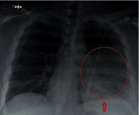 Anterior-posterior (AP) chest X-ray demonstrating a focal area of increased opacity in the left lower lobe, consistent with pulmonary consolidation and pneumonia. A red circle highlights the affected region, while a red arrow points to the blunting of the left costophrenic angle, indicating a trace pleural effusion. The right lung appears clear with no pneumothorax or visible focal consolidations. A thin, radiopaque medical line (likely a central venous catheter or monitoring lead) is visible traversing the upper chest toward the right atrium. The cardiac silhouette and mediastinal contours are within normal limits for an AP projection. No obvious fractures or osseous lesions are identified in the ribs or clavicles. This image serves as a clinical example of community-acquired or secondary pneumonia in an adult patient, illustrating key radiological markers of lower respiratory infection and associated parapneumonic effusion.