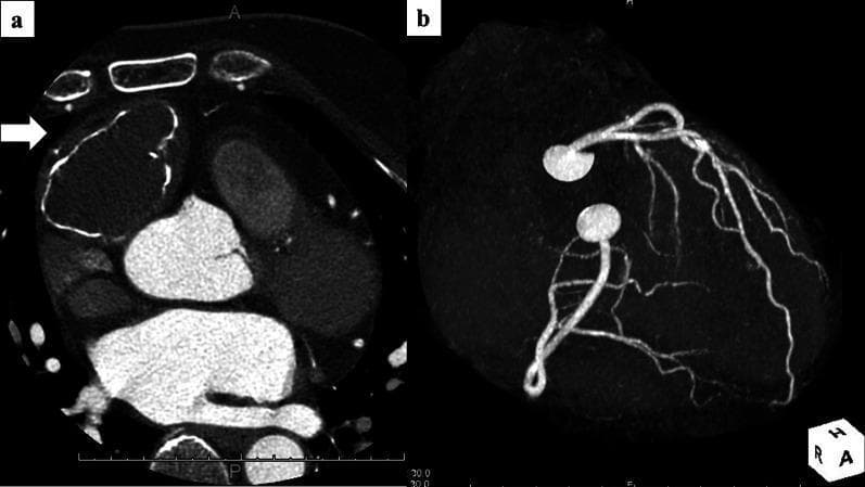 This dual-panel image displays diagnostic cardiovascular imaging. Panel (a) is an axial chest CT scan showing a large, well-circumscribed mass (white arrow) measuring approximately 50 x 45 x 40 mm in the anterior mediastinum, adjacent to the heart. The mass exhibits central intermediate attenuation and prominent, irregular marginal calcification along its periphery. Panel (b) shows a 3D reconstruction from a Coronary CT Angiography (CCTA) visualizing the coronary artery tree. The reconstruction demonstrates normal coronary anatomy without evidence of coronary aneurysms, stenosis, or abnormal feeding arteries originating from the coronary circulation to supply the mediastinal mass. These findings are clinically significant in the differential diagnosis of anterior mediastinal tumors, such as mature cystic teratomas, and in preoperative planning to exclude vascular involvement or parasitized blood supply from the coronary arteries.