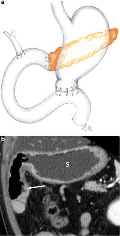 This figure illustrates the postoperative anatomy following a classic Whipple procedure (pancreaticoduodenectomy) through a comparative format. Part A is an anatomical diagram showing the reconstructed gastrointestinal tract, highlighting the gastrojejunostomy, hepaticojejunostomy, and pancreaticojejunostomy. The diagram emphasizes the resection of the pancreatic head, duodenum, and gallbladder with subsequent enteric anastomoses. Part B is a coronal CT image providing clinical correlation of these changes. In the CT scan, the stomach is labeled with an 's' and appears distended with low-attenuation fluid or contrast. A white arrow indicates the gastrojejunostomy, where the gastric antrum has been resected and the stomach is anastomosed to a jejunal loop. The imaging highlights the altered spatial relationships in the upper abdomen, specifically the positioning of the stomach and the efferent enteric loop. This material serves as an educational resource for identifying normal postoperative imaging findings and surgical landmarks after complex hepatobiliary surgery.