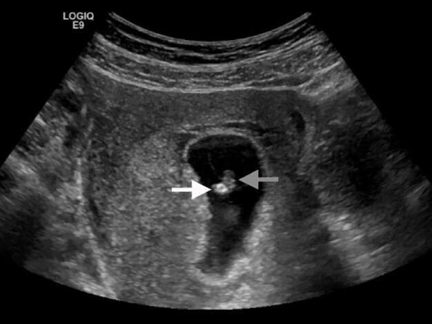 This diagnostic image is a transvaginal sonogram representing early pregnancy within the obstetric domain. The scan demonstrates a well-defined, anechoic (black) gestational sac located within the uterus. Centrally located within this sac are two distinct structures: a fetal pole, indicated by a gray arrow, appearing as a small, intermediate-echoic structure, and an adjacent echogenic yolk sac, indicated by a white arrow. The yolk sac displays higher echogenicity (hyperechoic/brighter) compared to the fetal pole. The surrounding myometrium and pelvic tissues exhibit a heterogeneous, granular echotexture typical of soft tissue. This visual serves as an educational example of early intrauterine pregnancy (IUP) and identifies the key sonographic landmarks required for dating and viability assessment. Clinical context suggests this image was captured during a point-of-care ultrasound (POCUS) evaluation in a patient presenting with symptoms of a potential threatened abortion, where the presence of these structures confirms an IUP but requires further assessment for cardiac activity.