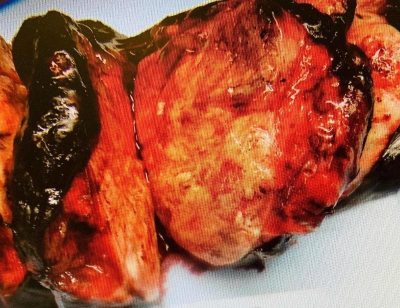 This clinical photograph shows a gross pathological examination of a resected human lung lobectomy specimen. The specimen features a large, well-circumscribed mass lesion that is predominantly grey-white in color with visible focal areas of hemorrhage and congestion. The tumor displays a firm consistency and occupies a significant portion of the parenchymal volume. Key anatomical findings include the mass protruding into the bronchial lumen and causing significant retraction of the overlying pleura, indicative of aggressive growth. The surrounding lung tissue shows secondary changes related to the mass effect. Clinically, this image demonstrates the macroscopic appearance of a primary lung malignancy, such as pulmonary carcinosarcoma, illustrating its expansive growth pattern and interaction with pleural and bronchial structures. This visual is suitable for pathology education regarding surgical staging and gross tumor morphology in thoracic oncology.