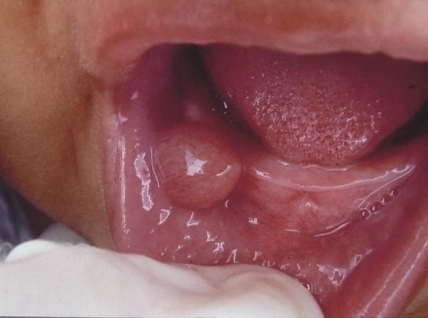 This clinical photograph shows an intraoral view of an infant's lower lip, highlighting a well-circumscribed, turgid nodular lesion characteristic of an oral mucocele (mucous extravasation cyst). The lesion is a raised, dome-shaped mass with a smooth, translucent surface that appears slightly shiny or bluish-pink, suggesting it contains fluid or semi-fluid mucous material. The surrounding labial mucosa is healthy and erythematous with visible fine vascularization. The tongue is partially visible in the background, displaying normal pinkish-red color and anatomical papillae. This image illustrates a common minor salivary gland disorder typically caused by local trauma or ductal obstruction, frequently encountered in pediatric dentistry and oral pathology for the clinical diagnosis of soft tissue swellings.