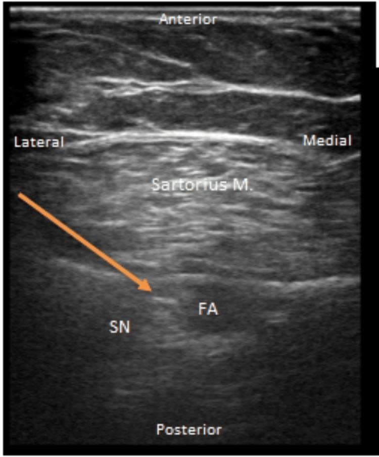 This diagnostic ultrasound image captures a transverse view of the right adductor canal, facilitating a regional anesthesia procedure. The anatomical landmarks are labeled according to their spatial orientation: Anterior, Posterior, Medial, and Lateral. Centrally, the sartorius muscle is visible as a hypoechoic structure with characteristic muscular striations. Deep (posterior) to the sartorius muscle, the femoral artery (FA) appears as an anechoic, pulsatile circular lumen. Positioned laterally to the femoral artery is the saphenous nerve (SN), which presents as a small, hyperechoic honeycombed structure. An orange arrow indicates the in-plane trajectory and tip of a Tuohy needle advancing toward the perineural space near the saphenous nerve for catheter placement. This imaging is characteristic of an adductor canal block, used in orthopedic pain management to provide sensory blockade to the knee and distal lower extremity while sparing motor function of the quadriceps.