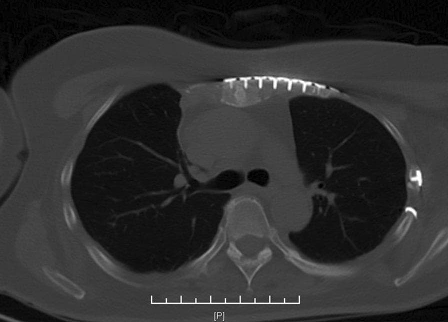 A transverse (axial) section of a CT scan of the thorax demonstrating postoperative internal fixation of costal cartilage fractures. The image reveals multiple radiopaque metallic hardware components, including long threaded plates and screws, positioned along the left anterior chest wall. The plates span the costal cartilages and are secured medially to the sternum and laterally to the osseous segments of the ribs. The lung parenchyma appears well-aerated with visible vascular markings. Anatomical landmarks include the sternum anteriorly, the thoracic spine and vertebral body posteriorly, and the bilateral ribs. The image illustrates a surgical management strategy for chest wall trauma, specifically focusing on the stabilization of costal cartilage fractures using titanium plating systems.