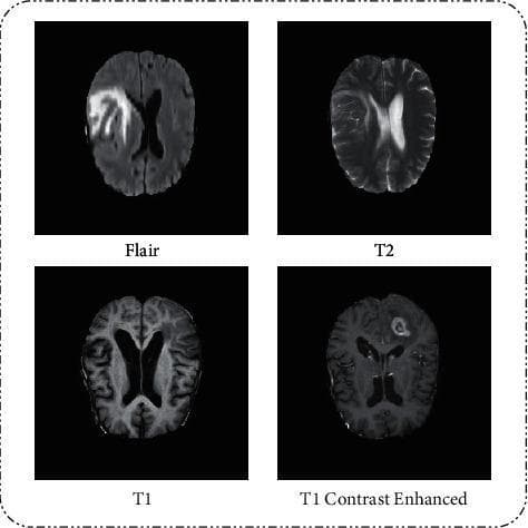 This diagnostic image provides a comparison of four axial MRI sequences of the human brain, used for neuro-oncological evaluation: FLAIR, T2-weighted, T1-weighted, and T1-weighted with contrast enhancement (T1CE). The FLAIR sequence highlights a large hyperintense (bright) region in the left cerebral hemisphere, representing vasogenic edema or non-enhancing tumor. The T2-weighted scan shows similar hyperintensity, particularly emphasizing cerebrospinal fluid and peri-ventricular changes. The native T1-weighted image provides anatomical detail with low signal intensity in the pathological regions. The T1CE image reveals a distinct, irregular ring-enhancing lesion in the right frontal/parietal area with a central hypointense core, suggestive of tumor necrosis, characteristic of high-grade glioma such as glioblastoma. This comparison illustrates how different MRI modalities allow for the differentiation of tumor core, enhancement, and surrounding edema in clinical diagnostics.