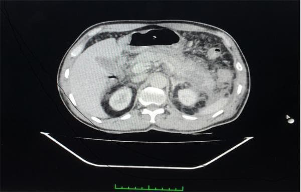 This diagnostic image is a contrast-enhanced computed tomography (CECT) scan of the abdomen in the axial plane, demonstrating acute necrotizing pancreatitis. The pancreas shows significant morphological changes, including a swollen neck and tail with indistinct margins and heterogeneous parenchymal enhancement. Specific areas of non-enhancement are visible, consistent with approximately 30% pancreatic necrosis. Extensive peripancreatic inflammation and fat stranding are evident, accompanied by fluid collections within the peritoneal cavity. These fluid collections are notably observed surrounding the kidneys and extending into the pararenal spaces. The stomach, partially visualized with an air-fluid level, and the liver are also present within the frame. This scan illustrates key radiological features used to calculate the modified CT severity index (CTSI) in the management of severe acute pancreatitis, specifically highlighting parenchymal necrosis and extra-pancreatic inflammatory involvement.
