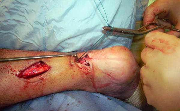 This clinical photograph captures an intraoperative view of an Achilles tendon reconstruction procedure on a patient in the prone position. Two longitudinal skin incisions are visible on the posterior aspect of the lower leg and ankle: a proximal incision exposing the gastrocnemius-soleus musculotendinous complex and a distal incision near the calcaneal insertion of the Achilles tendon. An intact skin bridge remains between the two surgical sites. The distal incision shows surgical manipulation with forceps holding a loop of green monofilament suture (identified as Maxon in context), which is being used to augment the tendon repair. A surgical retractor is positioned to maintain exposure of the proximal tendon stump. The surrounding tissue displays signs of acute surgical intervention, including minor bleeding and exposed subcutaneous fat. This image demonstrates a minimally invasive or limited-open technique for chronic or acute tendon rupture repair, emphasizing the anatomical localization of incisions to avoid the sural nerve while facilitating the passage of graft material or augmentation sutures.