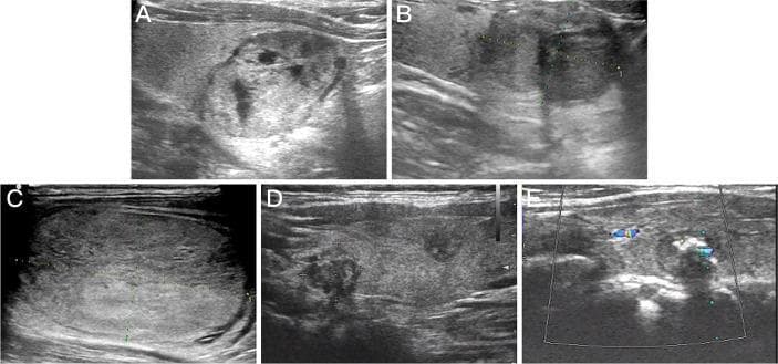 This composite diagnostic image features five B-mode and Doppler ultrasound scans (labeled A-E) of the thyroid gland, illustrating the sonographic variability of Bethesda IV thyroid nodules. Panel A demonstrates a follicular thyroid adenoma, characterized by an isoechoic to hypoechoic texture with internal cystic changes and a distinct hypoechoic halo. Panel B shows a follicular variant of papillary thyroid carcinoma (FVPTC), appearing as a hypoechoic nodule with well-defined margins. Panel C displays follicular thyroid carcinoma (FTC) as a predominantly isoechoic mass with noticeably irregular borders. Panel D illustrates multifocal papillary thyroid carcinoma (PTC) with multiple hypoechoic regions and irregular, poorly defined margins. Panel E shows medullary thyroid carcinoma (MTC) with color Doppler overlay indicating internal vascularity. This series serves as a clinical reference for comparing echogenicity (isoechoic vs. hypoechoic), margin characteristics (regular vs. irregular), and internal architecture (cystic vs. solid) across various benign and malignant thyroid pathologies identified during preoperative screening.