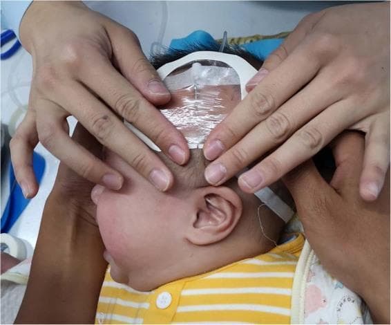 This clinical photograph demonstrates a scalp indwelling needle (SIAI) procedure for intravenous access in an infant. The infant is positioned in a lateral recumbent profile. A peripheral IV catheter is inserted into a superficial scalp vein, secured with a transparent adhesive semi-permeable dressing that allows for continuous monitoring of the insertion site. The dressing is further reinforced with white medical tape around its perimeter. Multiple hands are visible: one set of hands is providing manual stabilization of the infant's head to prevent movement, while another set of hands (likely the clinician's) is carefully smoothing the adhesive dressing to ensure a secure seal. This image illustrates pediatric procedural medicine, specifically focusing on vascular access techniques in neonates and infants where peripheral limb access may be difficult. The educational focus is on the correct placement, stabilization, and sterile dressing application for scalp vein cannulation.