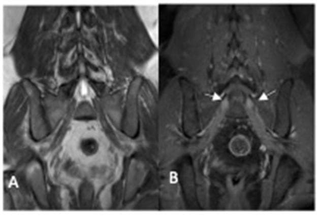 This diagnostic image pair displays coronal T1-weighted MRI scans of the lumbosacral plexus. Image A is a non-contrast study, and Image B is a post-contrast study. The anatomical region focuses on the lower lumbar spine, sacrum, and pelvis. In image A, the exiting sacral nerve roots appear as relatively hypo-intense (darker) structures compared to the surrounding pelvic musculature and fat. In image B, the same nerve roots (indicated by white arrows) demonstrate marked gadolinium enhancement and visible hypertrophy. This combination of nerve root enlargement and post-contrast enhancement is a key radiological finding in chronic inflammatory or hereditary polyneuropathies, such as Charcot-Marie-Tooth disease. The images clearly illustrate the contrast between normal spinal canal structures and pathologic lumbosacral plexus involvement, emphasizing the diagnostic utility of post-contrast T1 sequences in identifying breakdown of the blood-nerve barrier or inflammatory infiltration in neural tissues.