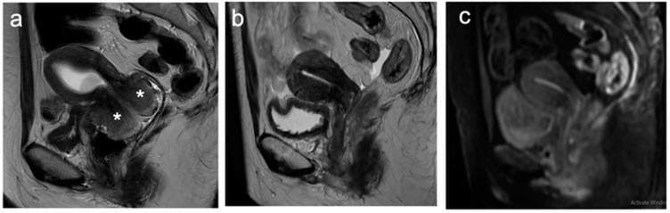 This diagnostic imaging composite displays three sagittal MRI views of the female pelvis, illustrating the therapeutic response of cervical cancer to chemoradiotherapy. Image (a) is a baseline sagittal T2-weighted image (T2WI) showing a large, exophytic cervical tumor marked with asterisks; the lesion exhibits intermediate signal intensity, contrasting with the hypointense fibrous stroma of the normal cervix. Image (b) presents a post-treatment sagittal T2WI, demonstrating a significant reduction in tumor volume and the reconstitution of the low-signal intensity cervical stroma, characteristic of a favorable treatment response. Image (c) is a post-treatment diffusion-weighted image (DWI) of the same plane, showing no residual areas of restricted diffusion or abnormal high signal intensity in the cervical region. The transition from the bulky baseline tumor in (a) to the resolved appearance in (b) and (c) serves as a clinical example of a complete radiological response to oncological therapy in a patient with locally advanced cervical cancer.