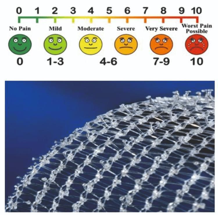 Educational medical graphic combining a pain assessment tool and surgical material. The top section displays a Visual Analog Scale (VAS) used for clinical pain measurement. The scale features a numeric rating from 0 to 10 correlated with descriptive labels and a Wong-Baker style faces scale: 0 (No Pain, dark green smiling face), 1-3 (Mild, light green smiling face), 4-6 (Moderate to Severe, yellow neutral to orange frowning faces), 7-9 (Very Severe, dark orange distressed face), and 10 (Worst Pain Possible, red crying face). Below the scale is a high-resolution photograph of a self-gripping prosthetic mesh used in surgical procedures like inguinal hernia repair. The mesh is composed of a translucent, white synthetic monofilament knit into a diamond-shaped grid. Characteristic micro-grips or bulbous nodes are visible at the strand intersections, designed for sutureless fixation to anatomical tissues. This comparison illustrates tools used for evaluating patient outcomes, specifically postoperative pain levels relative to surgical techniques and materials.