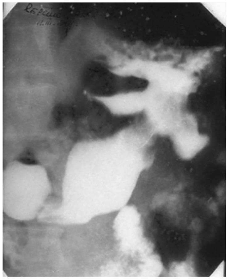 This diagnostic fluoroscopic image is a barium meal study of the upper gastrointestinal tract, specifically focusing on the stomach. The image reveals a significant structural deformity in the median third of the gastric body. A giant ulcer is visible, characterized by a large, deep, and irregular barium-filled cavity that projects beyond the normal gastric contour. This lesion exhibits a classic 'clover-leaf deformity,' where the barium collection is divided into multiple lobes or outpouchings, often resulting from extensive tissue loss and associated scarring or muscular contraction. The surrounding gastric anatomy appears distorted by the size and depth of the crater. This radiographic presentation is typical of a pseudoneoplastic benign giant gastric ulcer, which can mimic malignant processes due to its morphology and extent. Key educational concepts illustrated include contrast radiography for peptic ulcer disease, recognition of the clover-leaf sign, and the differentiation of giant benign ulcers from neoplastic gastric lesions.
