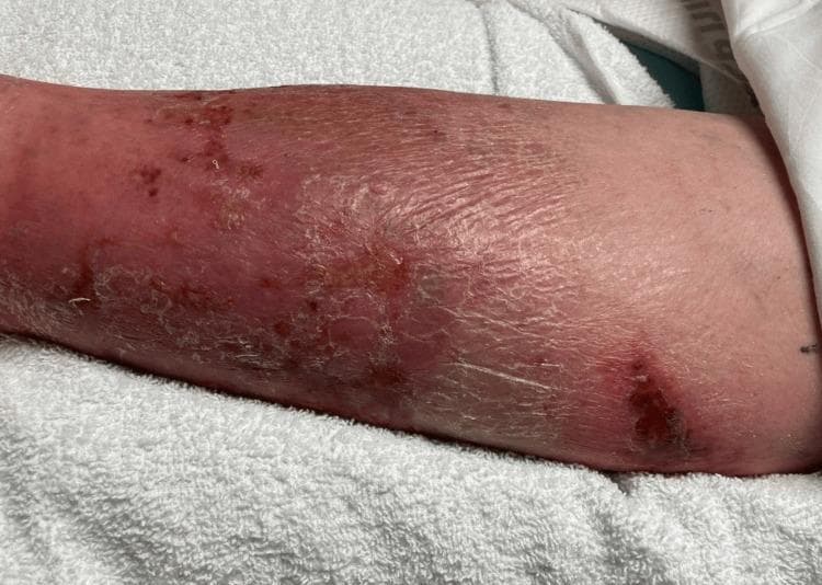 This clinical photograph displays the lower extremity of a patient, demonstrating classic physical examination findings of cellulitis. The skin exhibits diffuse erythema and swelling extending across the anterior and lateral aspects of the leg. The texture is notably compromised, showing signs of desquamation (peeling), xerosis (dryness), and lichenification, particularly in the mid-to-lower portion. Multiple discrete skin lesions are visible, including areas of darker, crusted scabbing and potential ulceration that may serve as a portal of entry for infection. Small petechiae or ecchymotic spots are scattered within the erythematous region. The presentation is highly characteristic of an acute bacterial skin and soft tissue infection (SSTI), emphasizing the visual transition from healthy proximal skin to distal inflamed, edematous, and scaling tissue. This image is an educational resource for identifying inflammatory dermatological conditions and assessing secondary skin changes associated with chronic or severe cellulitis.