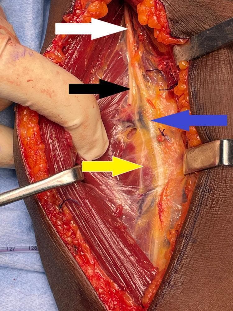 This clinical photograph displays a surgical dissection of the right proximal forearm and elbow region, utilizing an extended Henry approach to visualize the radial nerve and its distal branches. The surgical field is retracted, exposing the deep muscular and neurovascular anatomy. A white arrow identifies the main trunk of the radial nerve as it descends between the brachialis and brachioradialis muscles. The branching pattern is clearly demarcated: a black arrow points to the posterior interosseous nerve (PIN), which dives toward the supinator muscle; a blue arrow indicates the superficial radial nerve, which continues distally under the brachioradialis; and a yellow arrow points to the motor branch supplying the extensor carpi radialis brevis (ECRB). The nerves appear as glistening, off-white cord-like structures set against the deep red, striated muscle tissue and yellow lobulated subcutaneous fat. This image serves as a high-fidelity anatomical reference for peripheral nerve surgery, demonstrating the critical spatial relationships between the radial nerve bifurcation and the surrounding musculature.