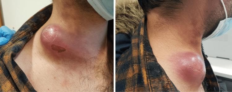 This clinical photograph consists of two panels showing the right lateral and anterolateral views of a patient's neck. The primary finding is a large, prominent, circumscribed mass approximately 6 cm in diameter located in the right cervical region. The overlying skin exhibits significant inflammatory changes, including intense erythema and a shiny, taut texture suggesting edema and underlying tension. There are areas of subtle desquamation and a small, darker, well-demarcated area that may represent a focal scab or localized skin necrosis. The mass appears fluctuant, which is characteristic of a cold abscess or severe lymphadenitis. Clinically, this presentation is highly suggestive of tuberculous lymphadenitis (scrofula) or a severe bacterial cervical lymphadenitis. The presence of a surgical mask on the patient and a blue-gloved hand in the frame indicates a clinical examination setting. This visual material is used to teach the physical signs of extrapulmonary tuberculosis and the differential diagnosis of unilateral cervical masses in adults.