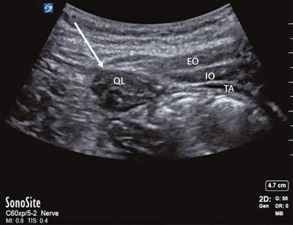This diagnostic ultrasound image demonstrates the sonographic anatomy of the posterior abdominal wall, specifically configured for a Quadratus Lumborum Block (QLB). The image shows four distinct muscle layers identified with labels: the External Oblique (EO), Internal Oblique (IO), and Transversus Abdominis (TA) muscles are visible as superficial, relatively hypoechoic parallel bands. Deep to these layers and located more posteriorly is the Quadratus Lumborum muscle (QL), which exhibits a more heterogeneous echotexture compared to the superficial abdominal wall muscles. A white arrow specifically indicates the posterior border of the QL muscle, which serves as a critical landmark for the deposition of local anesthetic in a posterior QL block approach. This clinical imaging is essential for regional anesthesia training, illustrating the spatial relationship between the anterolateral abdominal wall muscles and the posterior lumbar musculature to ensure safe needle placement and effective analgesic distribution.