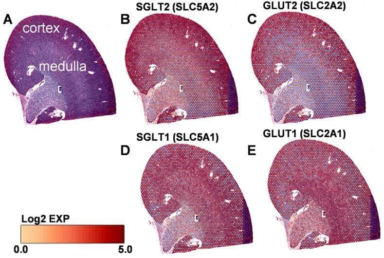 This composite diagnostic image showcases spatial transcriptomics data from a mouse kidney, illustrating the regional distribution of key glucose transporters. Panel A provides a histological reference snapshot, clearly labeling the outer cortex and inner medulla. Panels B through E display the spatial expression patterns for four transporters: SGLT2 (SLC5A2), GLUT2 (SLC2A2), SGLT1 (SLC5A1), and GLUT1 (SLC2A1). A Log2 expression color scale (0.0 to 5.0) at the bottom indicates that warmer red/orange tones represent higher transcript abundance, while cooler purple/blue tones indicate lower expression. The images demonstrate that SGLT2 (Panel B) and GLUT2 (Panel C) are most abundantly expressed within the renal cortex, corresponding to the S1 and S2 segments of the proximal tubules where the majority of glucose reabsorption occurs. Conversely, SGLT1 (Panel D) and GLUT1 (Panel E) show higher expression in the corticomedullary junction and medullary regions, correlating with the S3 segment of the proximal tubule. This visual comparison highlights the functional specialization of renal segments in glucose homeostasis.
