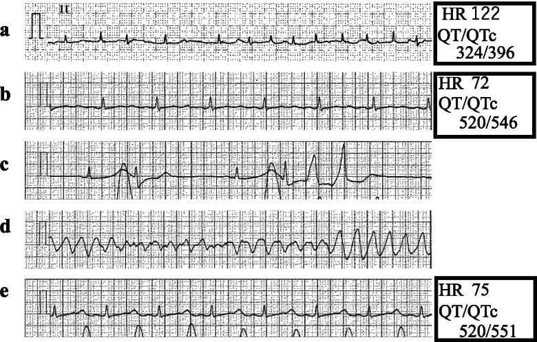 This diagnostic image consists of five sequential electrocardiogram (ECG) rhythm strips (Lead II) demonstrating perioperative rhythm changes and life-threatening arrhythmias. Panel A shows atrial fibrillation characterized by an irregular R-R interval and absent P waves (HR 122 bpm, QTc 396 ms). Panel B illustrates a conversion to normal sinus rhythm with visible P waves but significant QT interval prolongation (QTc 546 ms). Panel C depicts the onset of ectopy with multifocal premature ventricular contractions (PVCs) appearing as wide, bizarre QRS complexes. Panel D captures a 15-second episode of Torsades de Pointes (TdP), a polymorphic ventricular tachycardia where the QRS complexes appear to twist around the isoelectric baseline. Panel E shows the resolution of ventricular arrhythmias following pharmacological intervention with isoproterenol, returning to a stable sinus rhythm with a heart rate of 75 bpm. This comparison serves as an educational tool for identifying drug-induced QT prolongation and its progression into TdP during anesthesia induction.