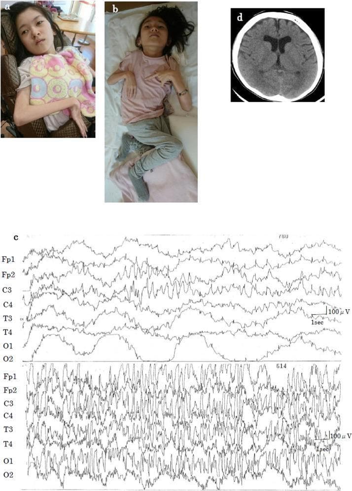 A multi-panel medical figure documenting the clinical presentation and neuroimaging of a pediatric patient with an epileptic encephalopathy. Panels (a) and (b) are clinical photographs showing a female patient with no distinct dysmorphic facial features. She exhibits physical signs of severe psychomotor delay and hypertonia, characterized by a recumbent, bedridden posture and contracted limb positioning. Panel (c) displays an electroencephalogram (EEG) tracing captured during the first seizure at 3 months of age, showing focal spikes in the central area (C3, C4) that transition into high-amplitude, generalized spike-and-wave discharges, indicating a seizure evolution. Panel (d) is an axial T2-weighted brain magnetic resonance image (MRI) taken at 13 years of age. It reveals mild bilateral frontal lobe atrophy and slight compensatory enlargement of the lateral ventricles (ventriculomegaly). This visual set serves as a clinical case study in pediatric neurology, illustrating the correlation between early-onset epilepsy, physical developmental delay, and progressive neuroanatomical changes such as cortical atrophy in neurodevelopmental disorders.