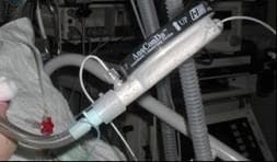 A clinical photograph of the AnaConDa® (Anaesthetic Conserving Device) integrated into a patient's respiratory circuit. This medical device functions as a miniature vaporizer and a gas-recirculation system for delivering inhaled anesthetics, such as sevoflurane, in intensive care settings. The image shows a cylindrical, partially transparent plastic device positioned between the patient's endotracheal tube and the ventilator tubing. Key visible features include the device's labeling with directional 'UP' arrows, a specialized gas line for anesthetic delivery, and internal components representing the heat and moisture exchange (HME) and activated carbon filter. The setup illustrates the clinical application of an anesthesia gas-recirculation system that replaces conventional filters while allowing for volatile sedation. The background contains standard intensive care monitoring equipment and ventilator hoses, demonstrating the device's role in critical care airway management.