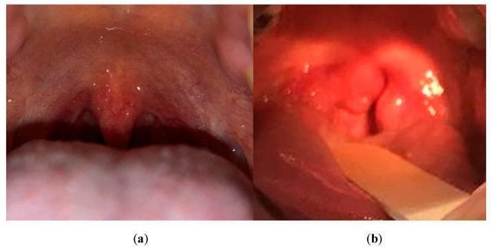 This comparison clinical photograph depicts a healthy throat (a) and a throat with pharyngitis, specifically strep throat (b). Image (a) shows normal oropharyngeal anatomy with a uniform pink mucosal lining, a neutral-sized uvula, and smooth tonsillar pillars without exudate or swelling. In contrast, image (b) demonstrates classic clinical signs of streptococcal pharyngitis, including significant erythema (redness) of the oropharynx, a swollen (edematous) uvula, and enlarged tonsils. Notably, whitish-yellow spots or patches, consistent with tonsillar exudates and petechiae, are visible on the inflamed tissue. The comparison highlights the transition from healthy smooth texture and consistent color to the irregular, highly vascularized, and exudative appearance characteristic of bacterial inflammation. This visual is used in medical education to assist in the clinical diagnosis of upper respiratory infections and to differentiate between normal anatomical variations and pathological inflammatory states.
