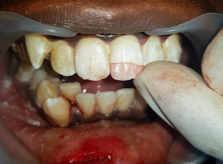 This clinical photograph displays an intraoral view of the maxillary and mandibular teeth, highlighting a dental trauma case. The primary focus is on the maxillary left central incisor (tooth 21), which exhibits an Ellis class II fracture with exposed dentin. A gloved finger is shown approximating a retrieved tooth fragment to the fractured incisal edge to check for fit and alignment prior to reattachment. The surrounding gingival tissues show signs of acute inflammation, including erythema and localized hemorrhage along the lower gingival margin, consistent with recent surgical intervention or trauma. The maxillary teeth appear to have some dental bonding or opaque white restorations, while the mandibular teeth show yellowish discoloration and extrinsic staining. Plastic cheek retractors are used to provide clear visualization of the surgical site. This image serves as an educational example of dental fragment approximation and the clinical management of crown fractures in restorative dentistry.
