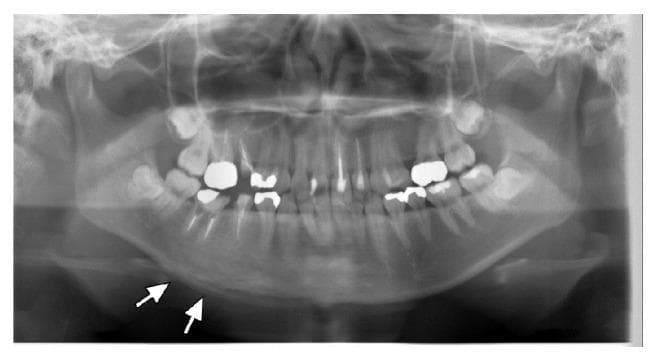 This orthopantomogram (OPG) provides a panoramic diagnostic view of the human maxilla and mandible, including full dentition. The primary pathological finding is localized to the right body of the mandible, where significant sclerotic changes are evident as increased radiopacity compared to the contralateral side. White arrows specifically highlight a periosteal reaction along the inferior border of the right mandible, characterized by a layered or 'onion-skin' appearance of new bone formation. These radiographic features are characteristic of chronic non-suppurative osteomyelitis or sclerosing osteitis. In this clinical context, the absence of obvious odontogenic infection and the presence of multifocal involvement elsewhere suggests SAPHO syndrome (Synovitis, Acne, Pustulosis, Hyperostosis, and Osteitis). The image serves as an educational example of inflammatory bone remodeling and reactive periostitis in the maxillofacial region.