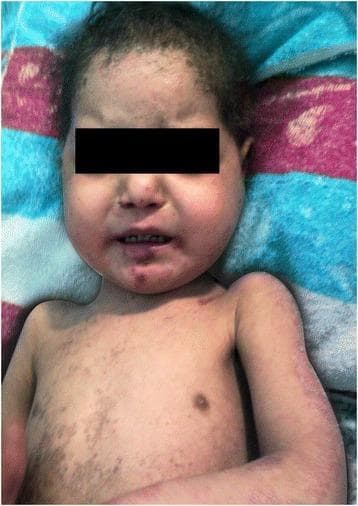 This clinical photograph displays the initial presentation of a pediatric patient with systemic dermatological manifestations of pellagra (niacin deficiency). The image shows a severe, scaly, desquamating skin rash with a widespread distribution across the face, neck, torso, and upper extremities. Key visual features include significant pigmentary alterations, characterized by areas of both hyperpigmentation and hypopigmentation, particularly prominent on the chest and arms. The facial rash exhibits erythema and scaling in a photosensitive distribution. Additional findings include thin, sparse scalp hair and visible scaliness on the scalp, potentially reflecting underlying nutritional compromise. The clinical presentation is consistent with the 'dermatitis' component of the pellagra triad, often associated with systemic conditions such as Hartnup disease or chronic malabsorption leading to secondary niacin deficiency. The educational focus is on recognizing the characteristic morphology and distribution of photosensitive nutritional dermatoses in a clinical setting.