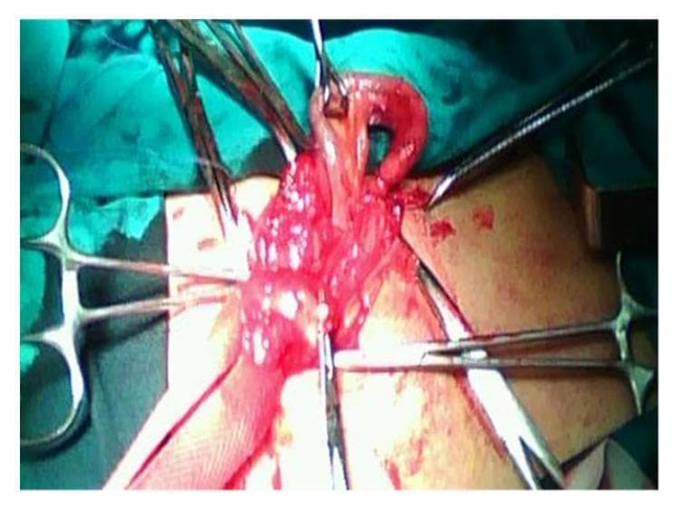 This clinical photograph shows an intraoperative view of an Amyand's hernia during a surgical repair. The image captures the right inguinal region where a hernia sac has been opened. Centrally, the vermiform appendix is clearly visualized as it is being mobilized from the inguinal canal. The appendix appears hyperemic, erythematous, and edematous, consistent with acute inflammation. Surrounding the appendix, part of the cecum and mesoappendix are visible. Multiple surgical instruments, including several hemostatic forceps (Kelly or Crile clamps) and retractors, are arranged radially to provide adequate exposure of the surgical field. The surgical site shows signs of fresh bleeding, typical of intraoperative dissection. This visual demonstrates a rare clinical entity where the appendix is found within an inguinal hernia sac, necessitating both appendectomy and hernia repair (in this case, via the Bassini technique). The image serves as a teaching tool for general surgery and emergency medicine regarding atypical hernia presentations.