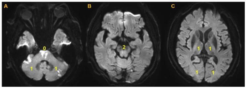 This diagnostic image consists of three axial panels (A, B, C) showing Diffusion-Weighted MRI (DWI) scans of the brain, demonstrating the application of the Posterior Circulation-Alberta Stroke Program Early Computed Tomography Score (PC-ASPECTS) for acute ischemic stroke assessment. Panel (A) at the level of the pons reveals distinct areas of focal hyperintensity (diffusion restriction) within the pons and bilateral cerebellar hemispheres, indicating acute infarction. Yellow numerical annotations indicate scoring: a '0' at the pons denotes significant involvement, while '1's in the cerebellar territories indicate infarctions involving less than 20% of the area. Panel (B) shows the midbrain level with a score of '2', indicating no acute diffusion restriction. Panel (C) displays the thalamic and posterior cerebral artery (PCA) territories, labeled with '1's to indicate no visible acute infarction in these specific regions. The total PC-ASPECTS score for this patient is 8, reflecting the burden of ischemia in the posterior circulation. This image is used to teach radiographic quantification of posterior circulation strokes and the systematic evaluation of brainstem and cerebellar ischemia.