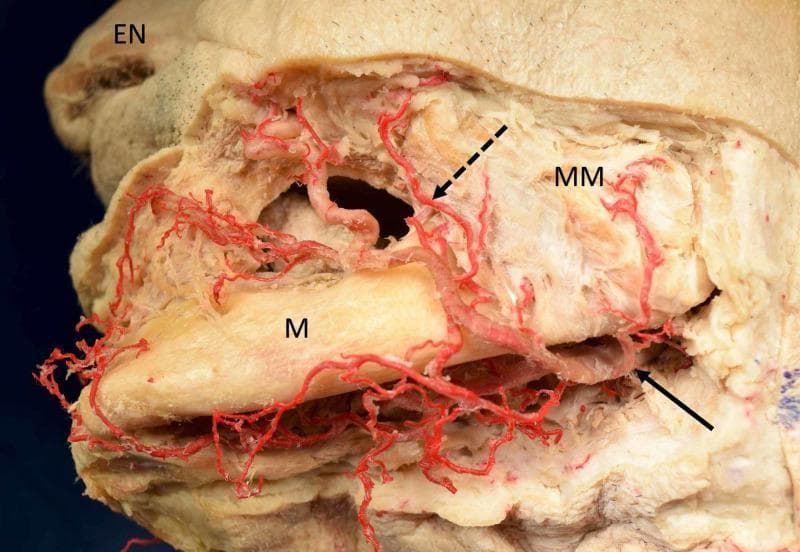 This clinical anatomical photograph shows a lateral view of a dissected Caucasian cadaveric specimen focusing on the vascular supply of the left lower face. The facial artery is highlighted by a solid arrow as it crosses the inferior border of the mandible (M) to enter the face. A prominent premasseteric branch (dotted arrow), also known as the masseteric or posterior branch, is seen ascending superficially over the masseter muscle (MM). The facial artery exhibits a tortuous course as it travels anteriorly toward the external nose (EN), giving off multiple smaller branches. The relationship between the arterial network and underlying musculoskeletal landmarks, specifically the mandible and masseter muscle, is clearly demonstrated. This image serves as an educational resource for plastic surgery, maxillofacial anatomy, and vascular studies, highlighting anatomical variations where the premasseteric branch may be strongly developed, especially in cases with variations in the maxillary artery.