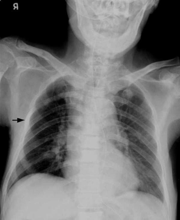This diagnostic image is an anteroposterior (AP) chest radiograph demonstrating diffuse, multifocal osteoblastic bone lesions. The skeletal structures, including the thoracic spine, bilateral ribs, scapulae, and clavicles, exhibit widespread increased bone density appearing as irregular, patchy regions of heightened radiopacity (sclerosis). A black arrow highlights a particularly conspicuous focal osteoblastic lesion on the lateral aspect of the right fourth rib, appearing markedly whiter and more opaque than the surrounding bone. These radiographic findings are characteristic of sclerotic/osteoblastic metastases, frequently associated with advanced prostate cancer in older male patients. The underlying lung fields and cardiac silhouette appear within normal limits relative to the significant skeletal pathology. This visual material is ideal for teaching radiological manifestations of systemic metastatic disease and differentiating between lytic and blastic bone lesions in a clinical oncology or radiology context.