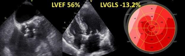 This composite diagnostic image features three panels representing a multimodal echocardiographic assessment of a patient with severe aortic stenosis. The left panel shows a grayscale 2D echocardiogram focusing on the aortic valve, demonstrating significant calcification and structural thickening. The central panel is an apical four-chamber view of the heart with an annotated Left Ventricular Ejection Fraction (LVEF) of 56%, indicating preserved systolic function. The right panel is a color-coded 'bullseye' polar plot illustrating speckle-tracking strain analysis. This plot maps regional longitudinal strain across segments of the left ventricle, including anterior (ANT), septal (SEPT), lateral (LAT), and posterior (POST) walls. A numerical value of -13.2% for Left Ventricular Global Longitudinal Strain (LVGLS) is displayed above the plot. The varying shades of red in the bullseye segments represent localized strain impairment, highlighting the clinical concept that global longitudinal strain can be significantly reduced even when the ejection fraction remains within normal limits. This visual is intended for cardiology and radiology education focusing on hemodynamic assessment and valvular heart disease.